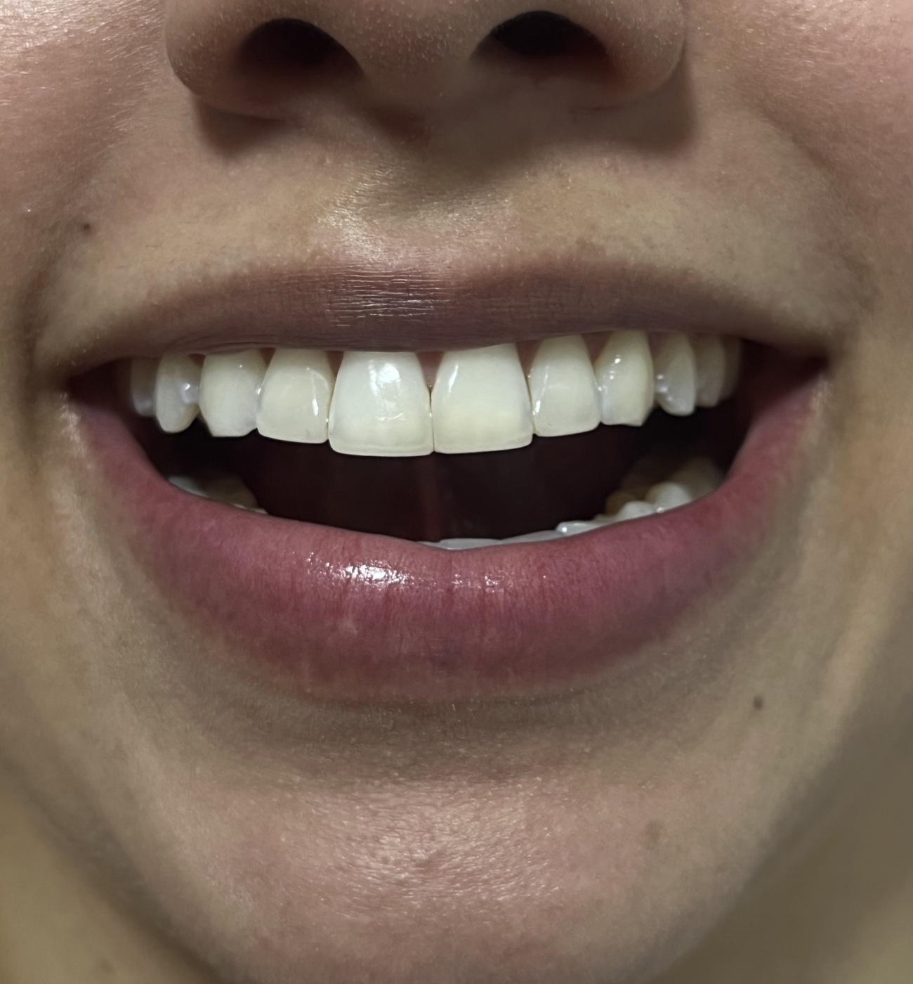 Antes de diseño de sonrisa con análisis estético dental