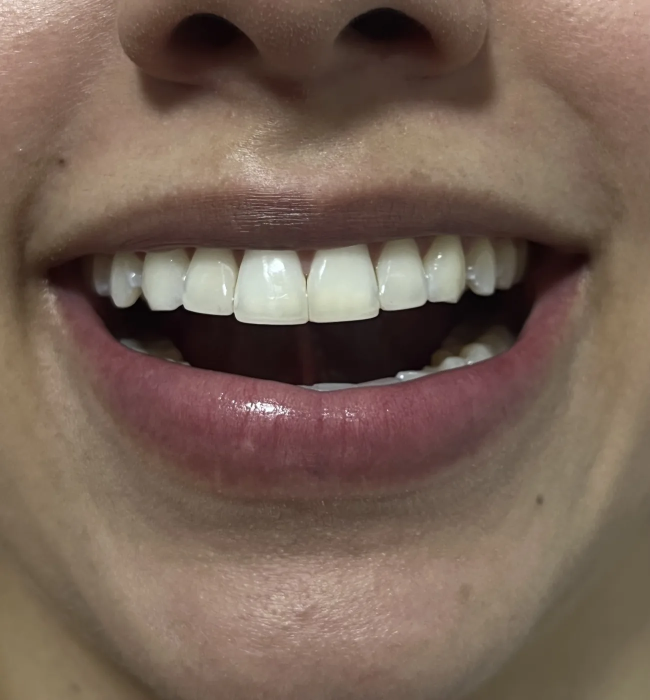 Antes de diseño de sonrisa con análisis estético dental