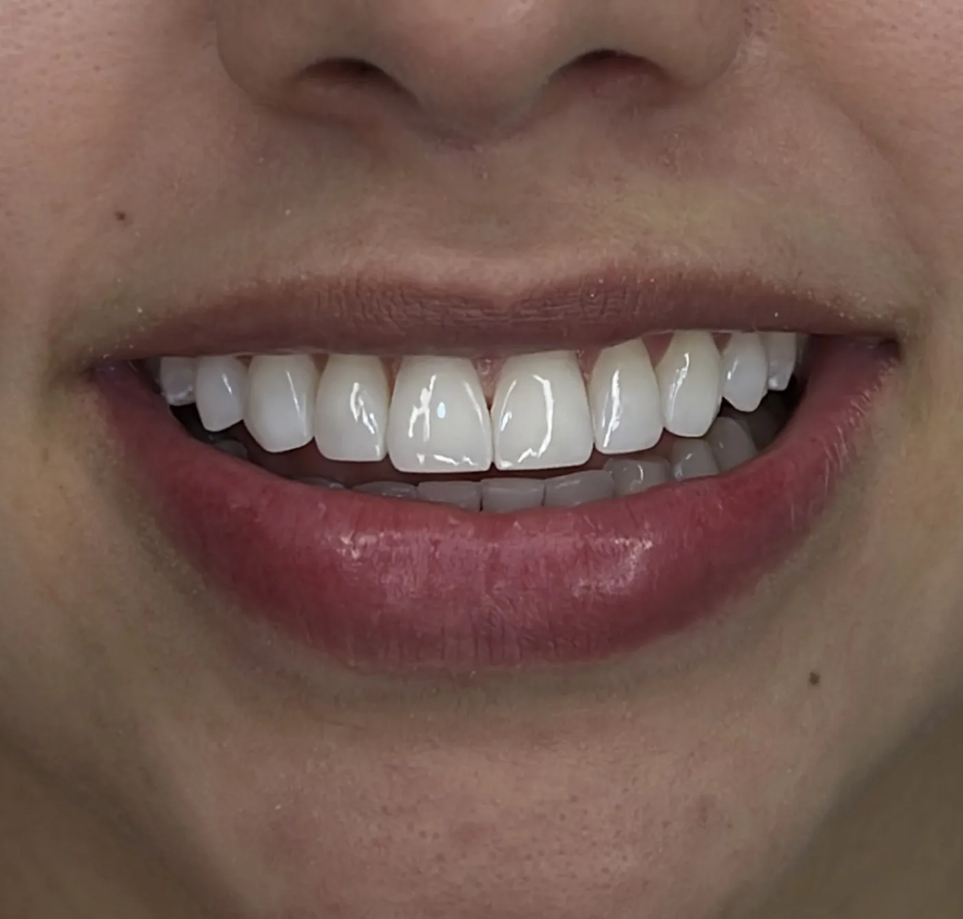 Después de diseño de sonrisa con proporción estética