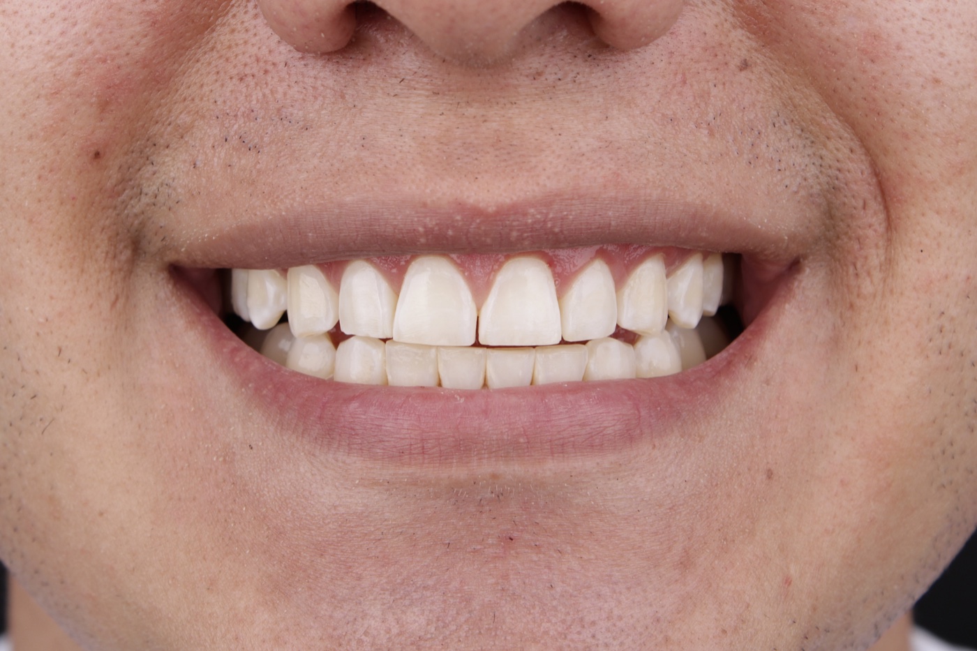 Antes de carillas dentales estéticas