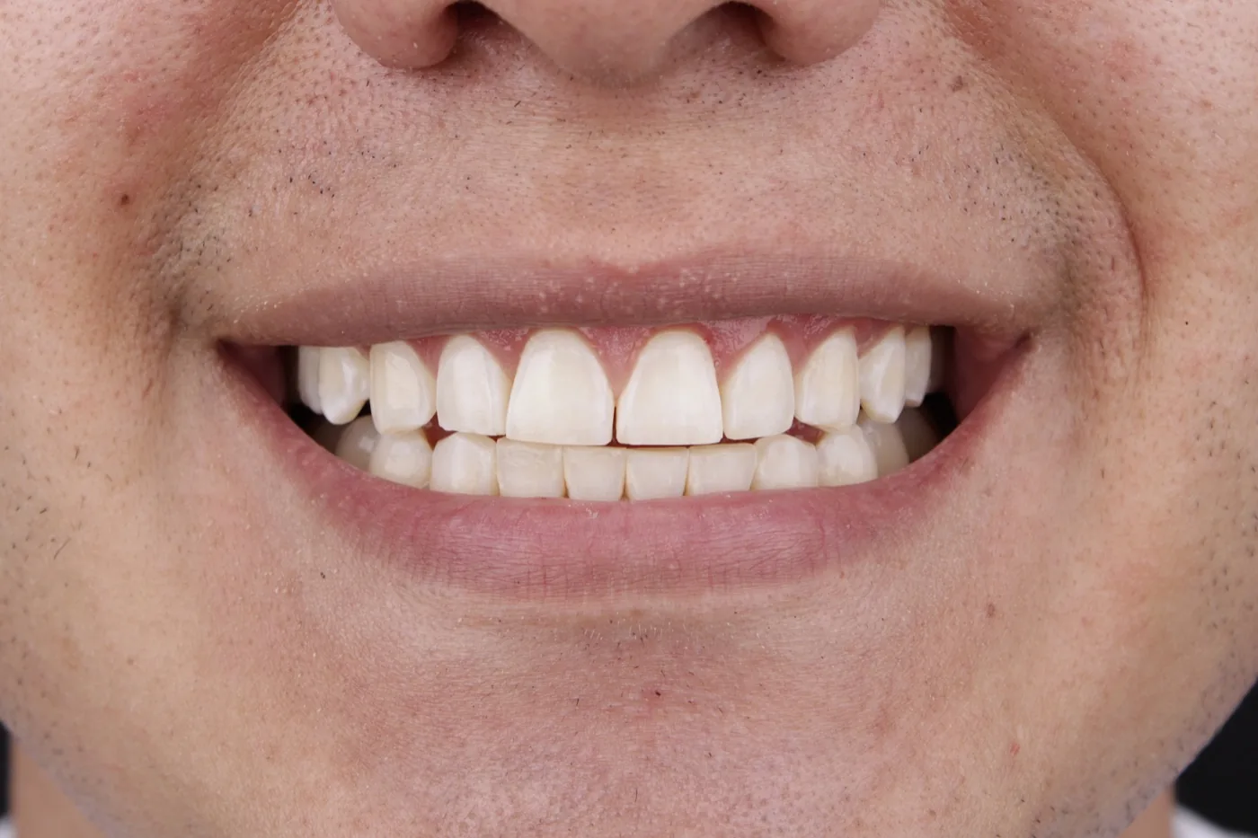Antes de carillas dentales estéticas