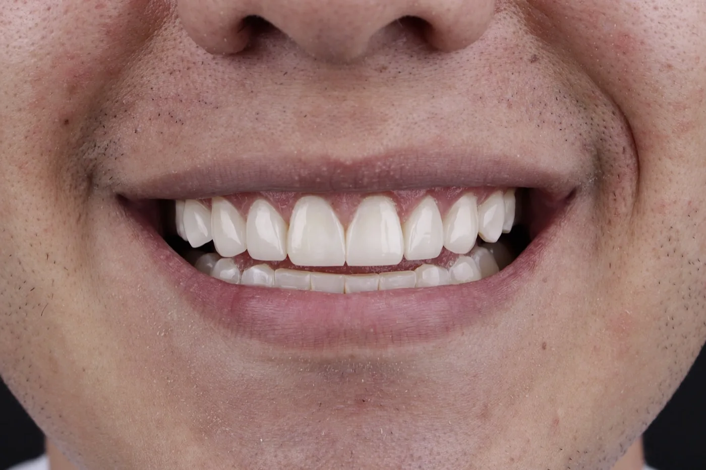 Después de carillas dentales estéticas
