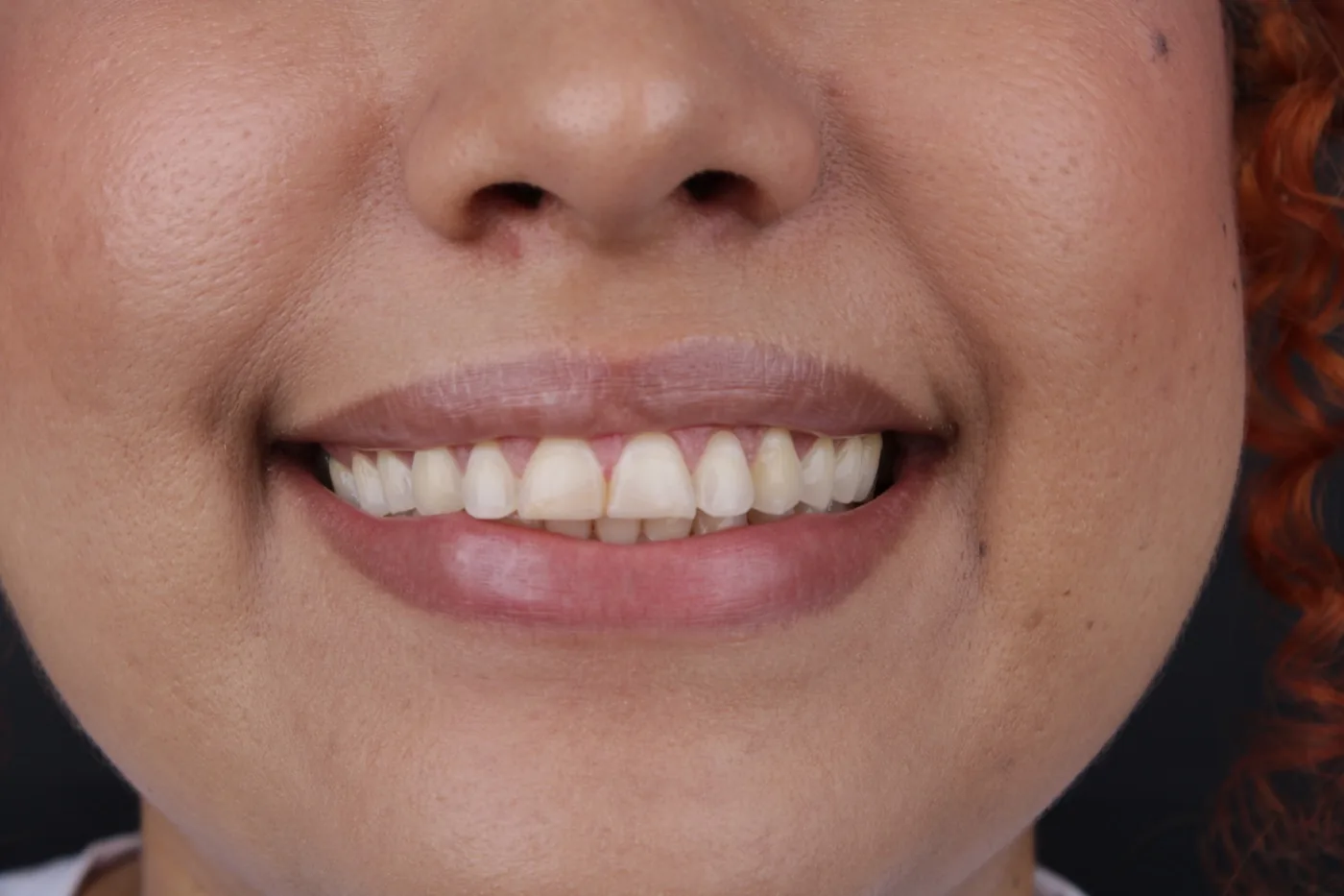 Antes de blanqueamiento dental estético