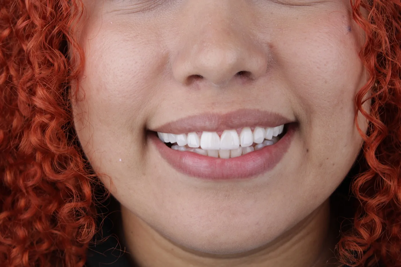Después de blanqueamiento dental estético