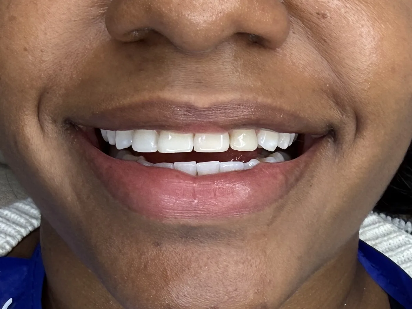 Antes de odontología estética con análisis de sonrisa
