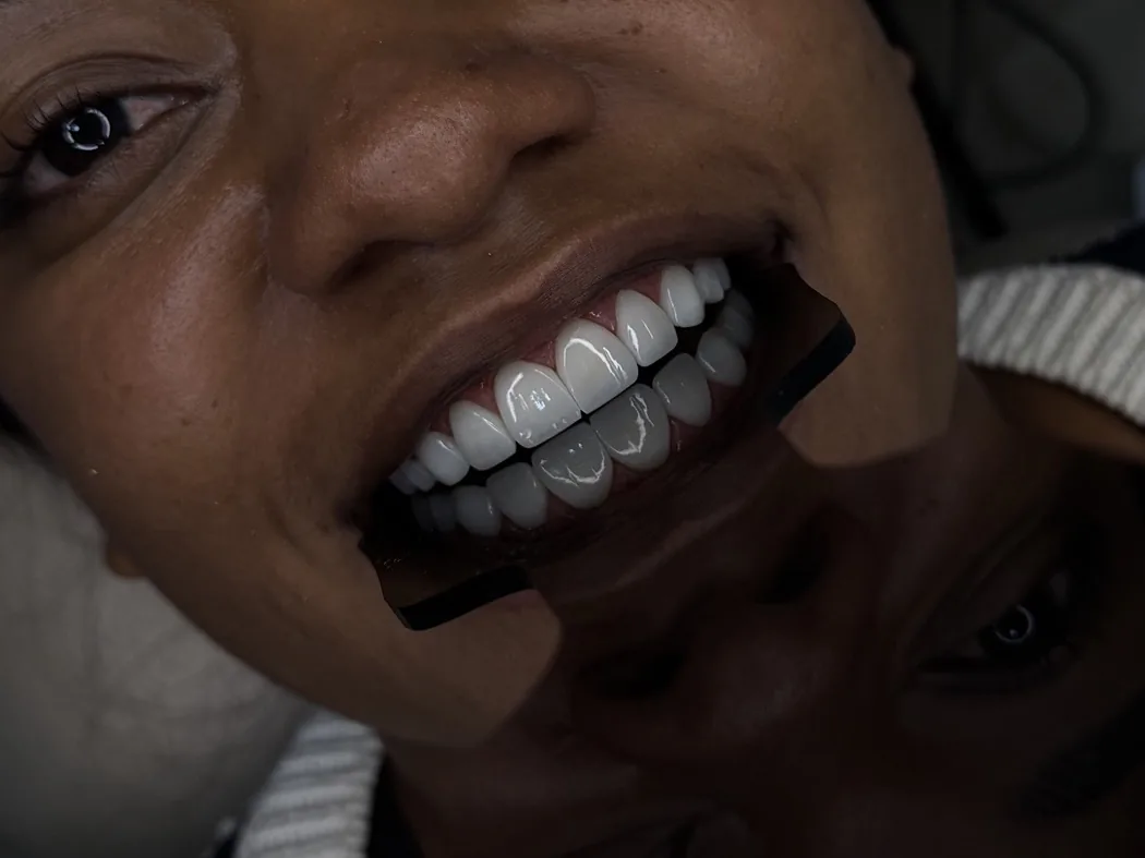 Después de odontología estética con armonía dental